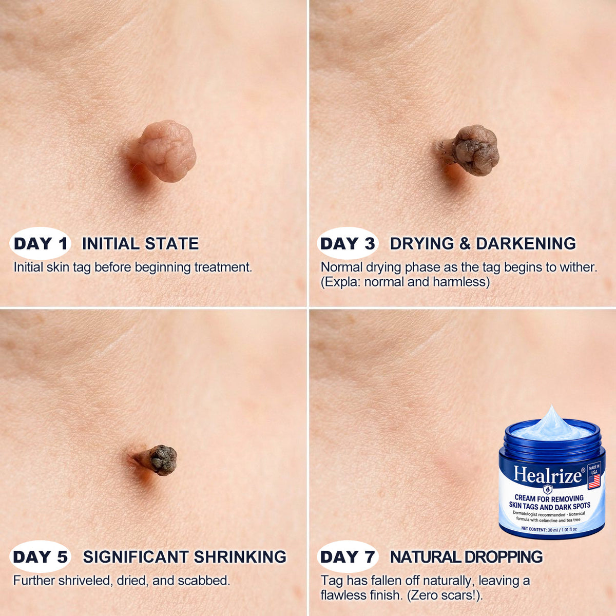 𝐇𝐞𝐚𝐥𝐫𝐢𝐳𝐞® 𝟕-𝐃𝐚𝐲 𝐒𝐤𝐢𝐧 𝐓𝐚𝐠 & 𝐒𝐩𝐨𝐭 𝐄𝐫𝐚𝐬𝐞𝐫 𝐂𝐫𝐞𝐚𝐦 (𝐙𝐞𝐫𝐨 𝐏𝐚𝐢𝐧, 𝐙𝐞𝐫𝐨 𝐒𝐜𝐚𝐫𝐬 𝐅𝐨𝐫𝐦𝐮𝐥𝐚)💎💎💎💎