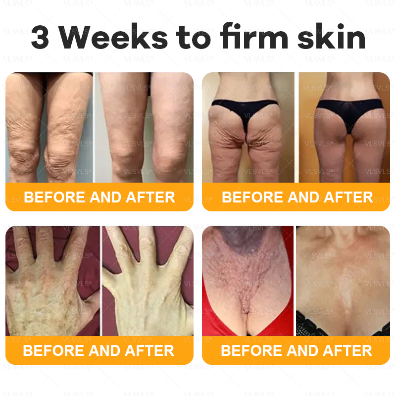 Made and Shipped from USA ✨ VLSVLS® Bee Venom Skin Restoration Cream 🌸 Anti-aging,Hydrating, Skin Repair, Even Tone, Acne and Dark Spot Treatment, Wart and Mole Removal, Psoriasis Relief 🔥 LAST DAY 80% OFF 💎