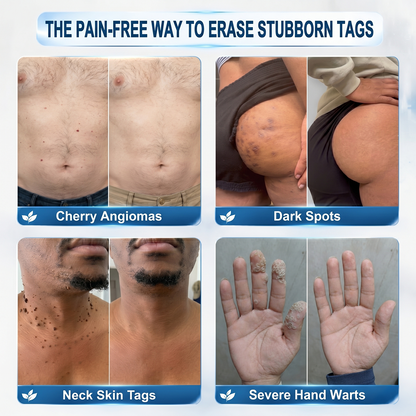 𝗛𝗜𝗦𝗞𝗜𝗡®👩‍⚕️ 𝟕-𝐃𝒂𝘆 𝐒𝗸𝐢𝐧 𝐓𝒂𝗴 & 𝐒𝐩𝙤𝐭 𝐄𝐫𝒂𝐬𝙚𝐫 Painless & Scar-Free Advanced Imperfection Removal Rollerball Pen