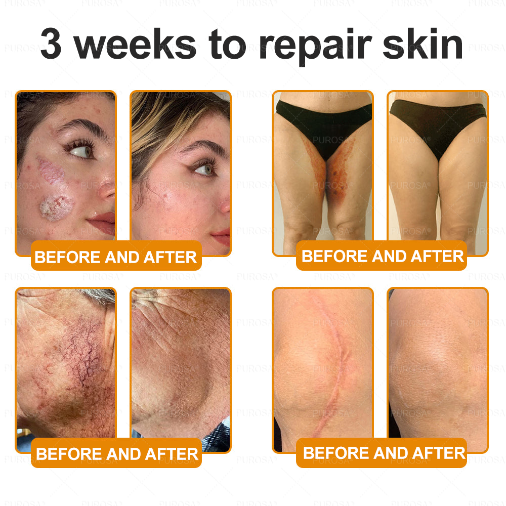 Made and Shipped from USA 🎇 VLSVLS® Bee Venom Skin Restoration Cream 🔥 LAST DAY 80% OFF☘️☘️