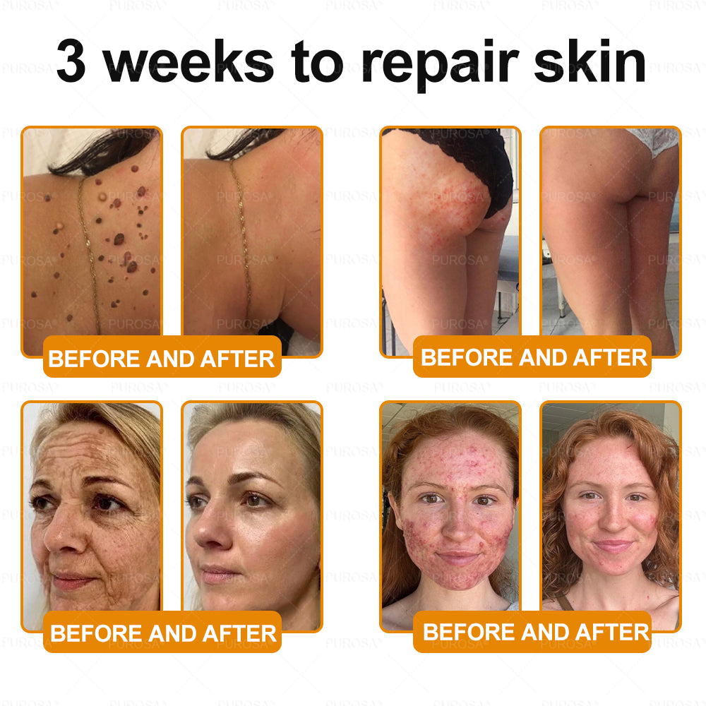 Made and Shipped from USA 🎇 VLSVLS® Bee Venom Skin Restoration Cream 🔥 LAST DAY 80% OFF☘️☘️