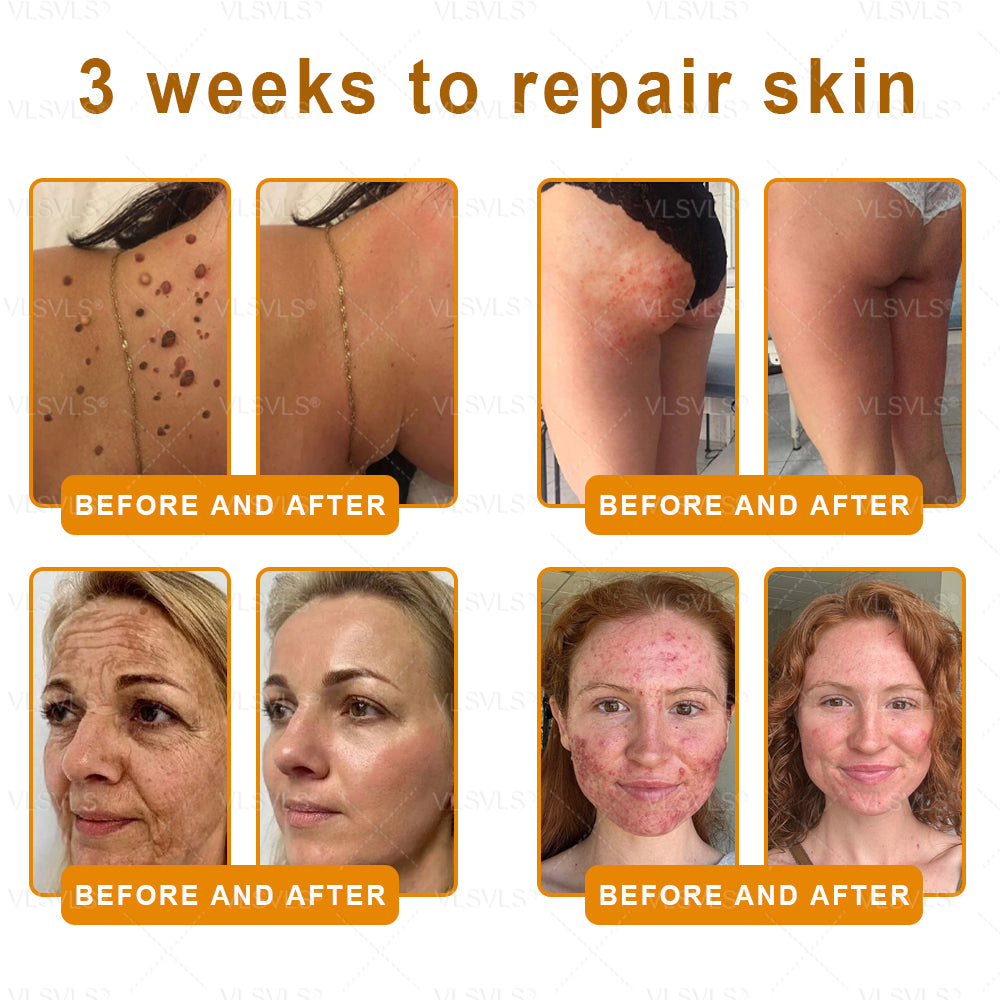 Made and Shipped from USA ✨ VLSVLS® Bee Venom Skin Restoration Cream 🌸 Anti-aging,Hydrating, Skin Repair, Even Tone, Acne and Dark Spot Treatment, Wart and Mole Removal, Psoriasis Relief 🔥 LAST DAY 80% OFF 💎