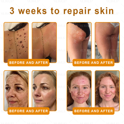 Made and Shipped from USA ✨ VLSVLS® Bee Venom Skin Restoration Cream 🌸 Anti-aging,Hydrating, Skin Repair, Even Tone, Acne and Dark Spot Treatment, Wart and Mole Removal, Psoriasis Relief 🔥 LAST DAY 80% OFF 💎