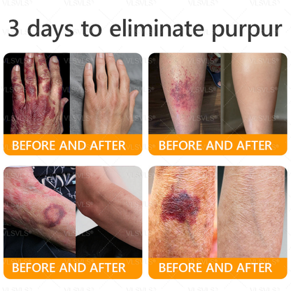 Made and Shipped from USA ✨ VLSVLS® Bee Venom Skin Restoration Cream 🌸 Anti-aging,Hydrating, Skin Repair, Even Tone, Acne and Dark Spot Treatment, Wart and Mole Removal, Psoriasis Relief 🔥 LAST DAY 80% OFF 💎