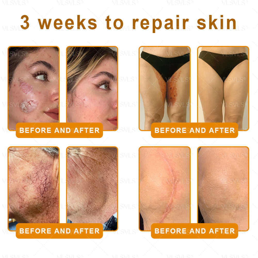 Made and Shipped from USA ✨ VLSVLS® Bee Venom Skin Restoration Cream 🌸 Anti-aging,Hydrating, Skin Repair, Even Tone, Acne and Dark Spot Treatment, Wart and Mole Removal, Psoriasis Relief 🔥 LAST DAY 80% OFF 💎